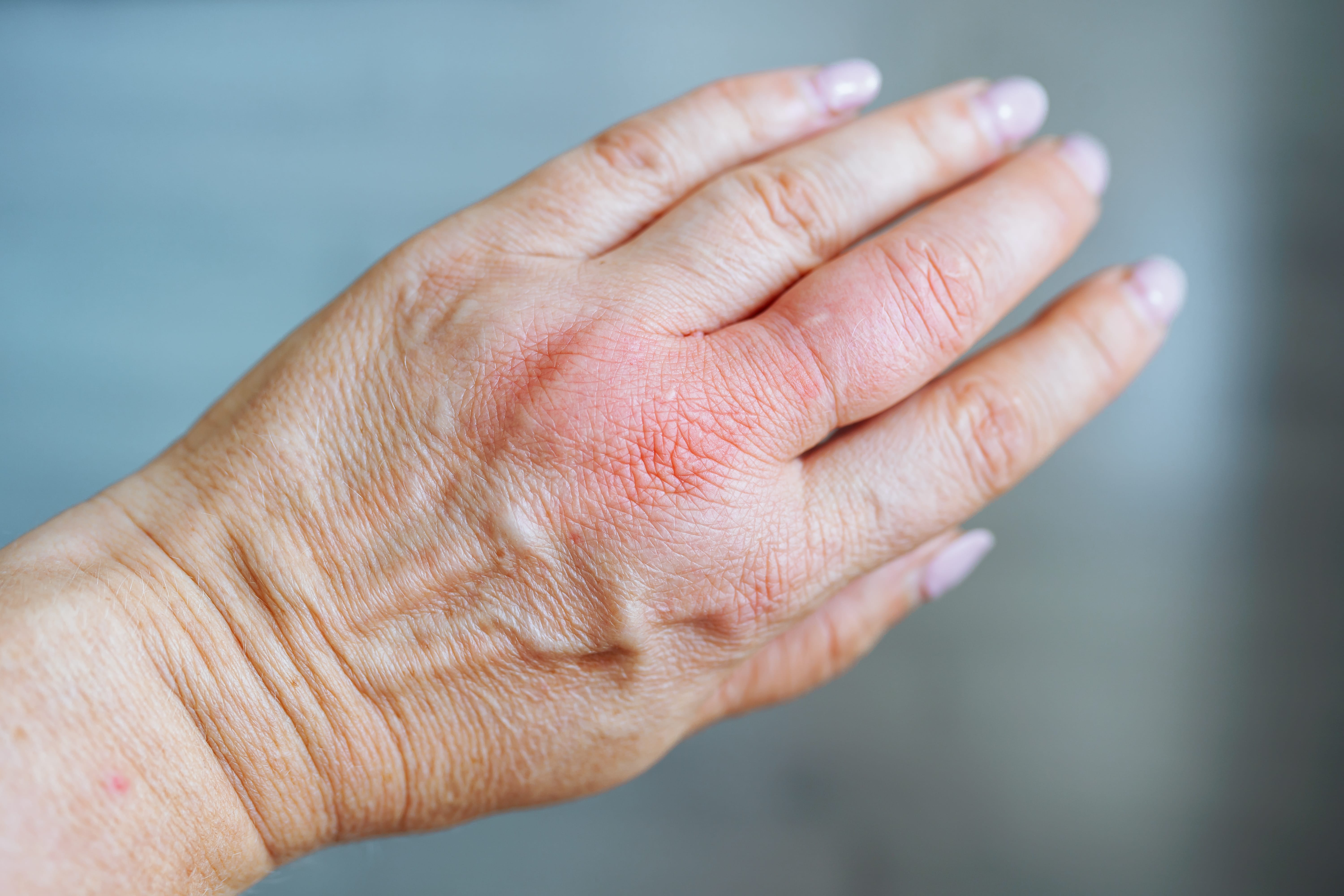 Hand that is red a swollen from a wasp sting or yellowjacket.